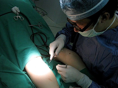 Cách 2: Cắt toàn bộ cơ sinh đôi. Bắp chân sẽ nhỏ đi nhiều sau khi cắt toàn bộ cơ sinh đôi. Tuy nhiên, nên nhớ rằng hình dáng của bắp chân quan trọng hơn là kích thước của bắp chân. So với bắp chân thon, bắp chân của phụ nữ có "bắp chân củ cải" thì cơ dầy hơn, như vậy thay vì làm lấy bỏ cơ bắp chân thì nên làm thế nào cho cơ mỏng đi. Hình dáng của bắp chân sau khi cắt toàn bộ cơ sinh đôi sẽ không tự nhiên.