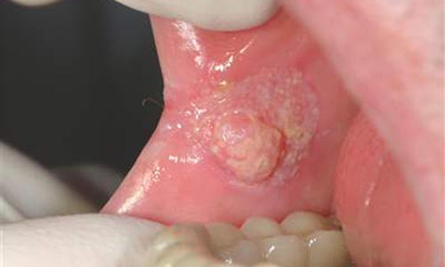 Thoi quen khien ban mac benh ung thu mieng