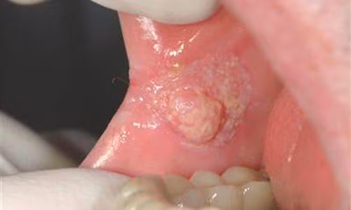 Thoi quen khien ban mac benh ung thu mieng