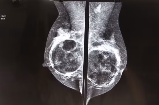 Tuyến vú bị biến dạng với các cục, khối do nâng ngực bằng chất làm đầy. Ảnh: Bác sĩ cung cấp Tuyến vú bị biến dạng với các cục, khối do nâng ngực bằng chất làm đầy. Ảnh: Bác sĩ cung cấp