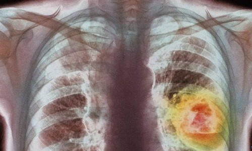 Ung thu phoi xam nhap, tan pha co the nhu the nao?