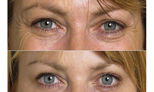 Bi quyet xoa nep nhan vung mat lay lai ve tre trung