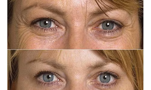 Bi quyet xoa nep nhan vung mat lay lai ve tre trung