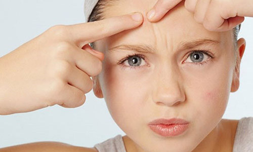 Tranh nan mun o nhung vi tri nay tren khuon mat