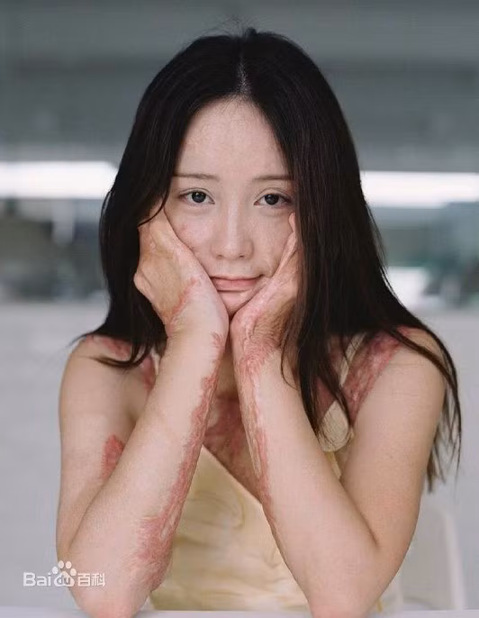 Được biết, vào năm 2011, ở tuổi 16, Chu Nham cao ráo và xinh đẹp hơn các bạn đồng trang lứa. Cô được nhiều tạp chí mời làm người mẫu tuổi teen. Và chính sự xinh đẹp của cô cũng được nhiều bạn nam trong trường để ý. Điển hình là Đào Nhữ Khôn đã chủ động tỏ tình nhưng bị cô từ chối. Tức giận, Đào Nhữ Khôn tưới xăng và thiêu sống Chu Nham. Dù được cứu nhưng cô bị bỏng nặng. Trong phiên tòa xử năm 2012, kẻ thủ ác bị tuyên án 12 năm tù và phải bồi thường 1,8 triệu NDT.