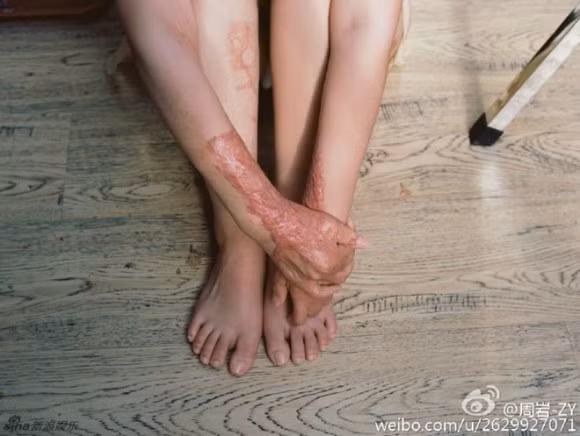 Cô cũng từng chia sẻ: “Ngày ngày tôi tốn quá nhiều tiền của gia đình cho thuốc thang, các liệu pháp phục hồi, phẫu thuật. Có nhiều lúc, tôi thấy mình giống như đời con nhộng”.