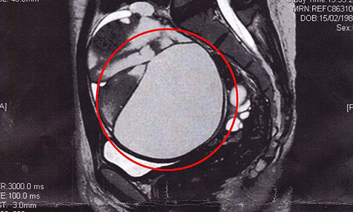 Choang phat hien khoi u 16cm trong o bung khi dat vong tranh thai