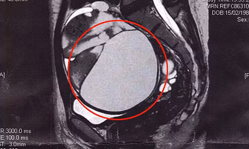 Choang phat hien khoi u 16cm trong o bung khi dat vong tranh thai