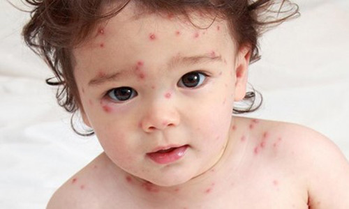 Bé bị nổi mụn nước khắp người vì thủy đậu.