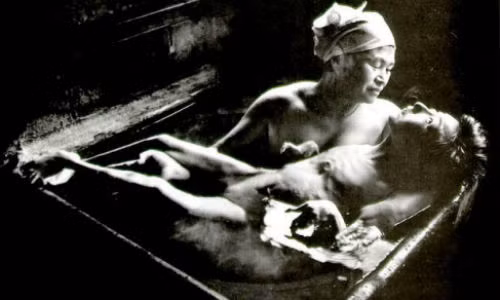 Bệnh nhân mắc bệnh Minamata có các triệu chứng tê liệt, co giật đến tử vong.