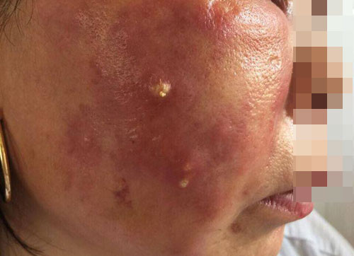 Nhiem trung mat nang ne vi ham lam trang da sieu toc-Hinh-2