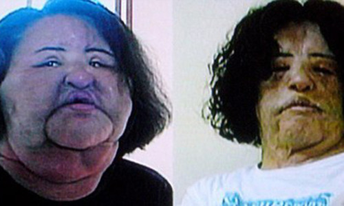 Cuu nguoi mau nhu quai vat vi nghien tiem dau an vao da