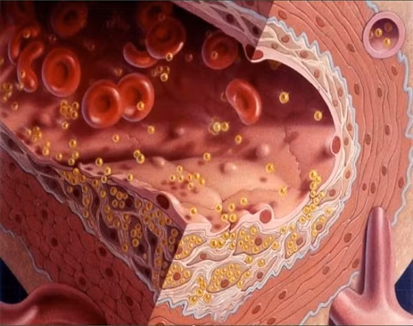 Trai, hến còn là thực phẩm tốt bổ sung chất béo omega-3, làm giảm lượng mỡ trong máu, kìm hãm, làm chậm lại sự phát triển của các mảng vữa động mạch, ngăn ngừa nguy cơ dẫn đến chứng xơ vữa động mạch và chứng đột quỵ.