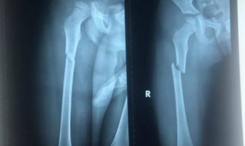 Phim chụp X-quang chân Thiện bị gãy. Ảnh: Khánh Trung.