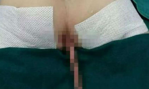 Cậu bé sinh ra với chiếc đuôi dài bất thường.