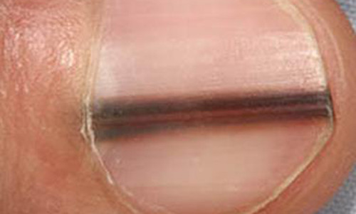 Doan biet 9 tinh trang suc khoe qua mong tay