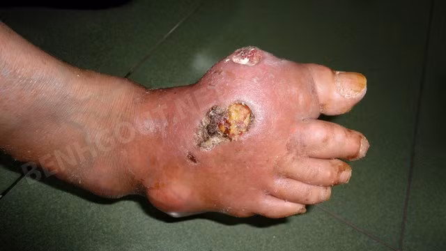 Người mắc bệnh gout phải đối mặt với nguy cơ bị hủy hoại khớp, đầu xương làm cho bệnh nhân bị tàn phế. Khi các hạt tôphi bị loét vỡ, khiến vi khuẩn xâm nhập vào trong khớp gây viêm khớp nhiễm khuẩn, nhiễm khuẩn huyết.