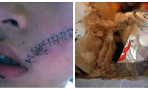 Chỉ vì cho lon nước ngọt vào ngăn đá tủ lạnh mà cậu bé này bị khâu 38 mũi trên mặt. Ảnh minh họa.