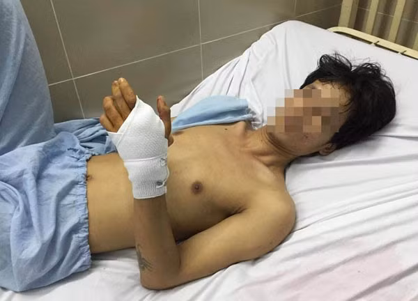 Anh L. với thương tích do đạn ở lòng bàn tay trái.