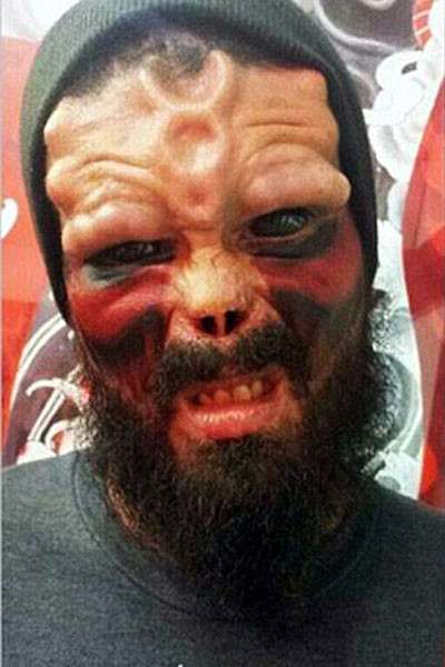 Henry Damon sau khi phẫu thuật được 3 tháng.