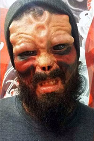 Henry Damon sau khi phẫu thuật được 3 tháng.