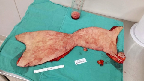 Miếng da thừa nhăn nheo sau khi giảm cân cô gái cắt bỏ.