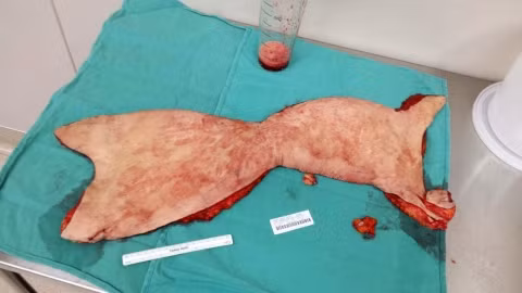 Miếng da thừa nhăn nheo sau khi giảm cân cô gái cắt bỏ.