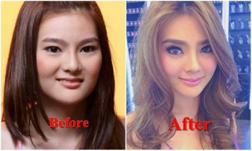 Người đẹp Thái Lan Due Arisara từng có khuôn mặt to với phần quai hàm bạnh, đôi mắt nhỏ. Nhưng sau khi thẩm mỹ, cô đã sở hữu gương mặt thon gọn, cằm V-line đúng mốt.