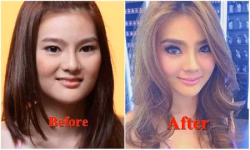 Người đẹp Thái Lan Due Arisara từng có khuôn mặt to với phần quai hàm bạnh, đôi mắt nhỏ. Nhưng sau khi thẩm mỹ, cô đã sở hữu gương mặt thon gọn, cằm V-line đúng mốt.