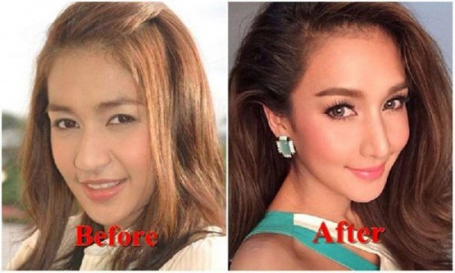 Noey Chotika từng sở hữu một khuôn mặt dễ nhìn, tuy nhiên, sống mũi của cô không được cao và thon gọn cho lắm. Nhờ phẫu thuật thẩm mỹ, Noey đã có một khuôn mặt thanh thoát hơn với đôi mắt to và chiếc mũi cao ráo.