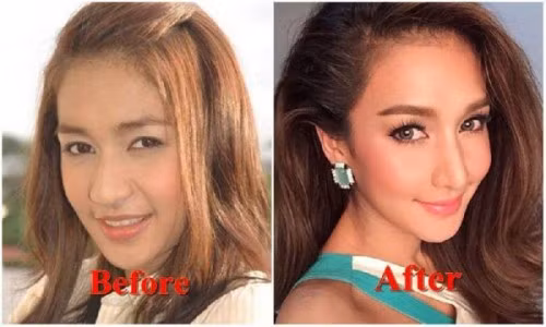 Noey Chotika từng sở hữu một khuôn mặt dễ nhìn, tuy nhiên, sống mũi của cô không được cao và thon gọn cho lắm. Nhờ phẫu thuật thẩm mỹ, Noey đã có một khuôn mặt thanh thoát hơn với đôi mắt to và chiếc mũi cao ráo.