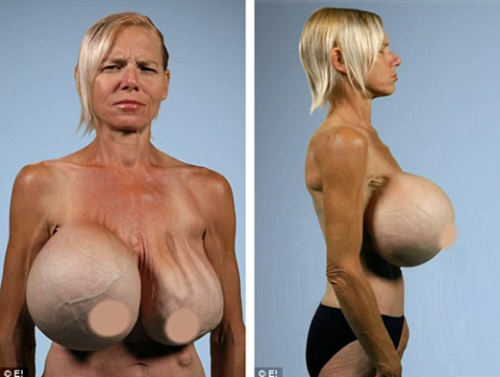 Người phụ nữ tên Dee Stein - 53 tuổi, sống ở Los Vegas (Mỹ) – đã tìm đến phẫu thuật thẩm mỹ để có một bộ ngực lớn hơn. Sau nhiều lần, bà đã nhờ bác sĩ đưa tăng thể mô bên trong ngực mình tới mức 3.000cc và sở hữu một bộ ngực khổng lồ. Nhưng không may, hậu quả của ca phẫu thuật cấy ghép sử dụng đôi lumen (với một lumen bên trong tạo bởi silicon và một lumen bên ngoài chứa đầy nước muối) là túi muối ở phần ngực trái làm nó xẹp xuống một cách khủng khiếp. Sau đó, bất chấp nguy cơ rủi ro cao, bà đã phải cầu cứu nhiều bác sĩ để cắt bỏ bộ ngực 14kg.