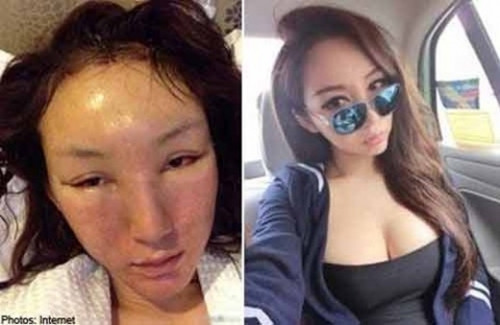 Một cô gái Trung Quốc tên Chen Yi Man sở hữu ngoại hình khá xinh xắn và vóc dáng chuẩn. Vì mong muốn gương mặt hoàn hảo hơn nên cô đã thực hiện phẫu thuật thẩm mỹ. Tuy nhiên ca phẫu thuật của cô không thành công như mong đợi và khuôn mặt biến dạng và "xuống cấp" trầm trọng.