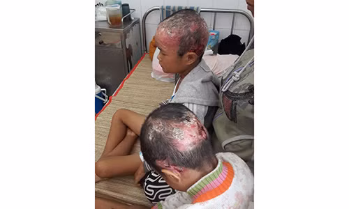 Hai anh em ruot quan quai vi mac benh da canh buom