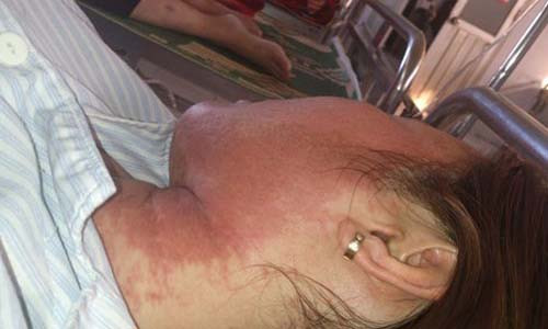 Di ung my pham gay hau qua kinh hoang