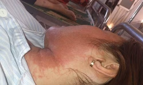 Di ung my pham gay hau qua kinh hoang