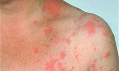 Nhung loai ung thu nguy hiem voi nam gioi