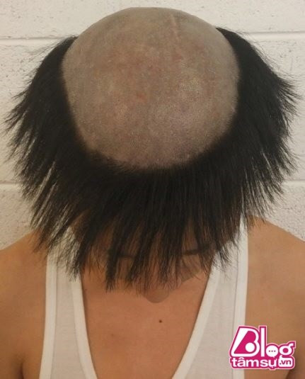 Chỏm đã hoàn toàn được cạo trọc.