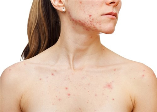 Biet nguyen nhan moc mun nho xac dinh duoc vi tri mun-Hinh-2