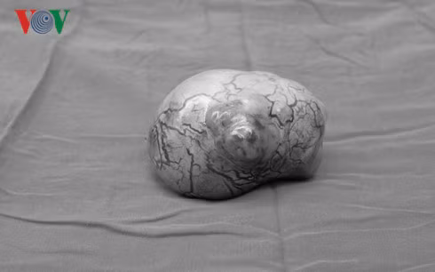 Tinh hoan mac lai o bung 20 nam ma khong biet-Hinh-2