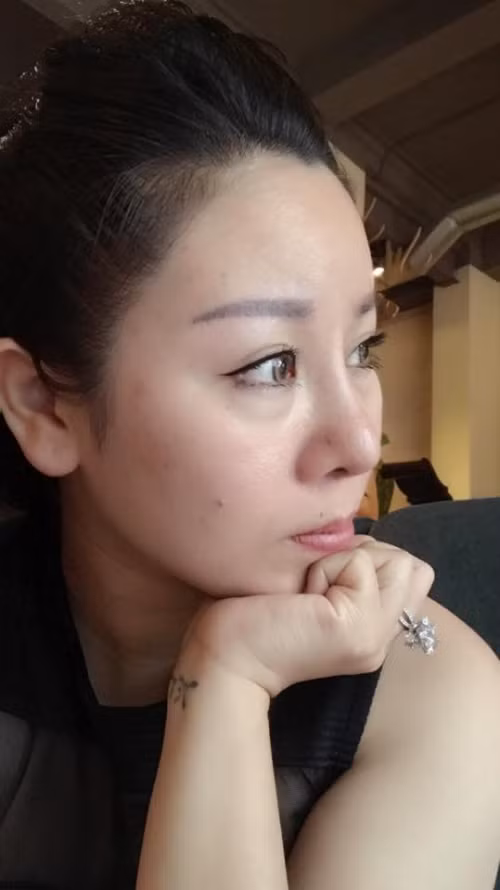 Đắng ngắt hậu quả phẫu thuật thẩm mỹ thất bại - Hình 3 Dang ngat hau qua phau thuat tham my that bai-Hinh-3