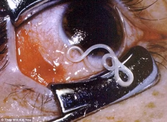 5. Bệnh ký sinh trùng sống trong mắt Giun filarial, còn được gọi là sâu Loa Loa, là loài ký sinh trùng có khả năng sống trong mắt của con người. Bệnh ký sinh trùng sống trong mắt này là nguyên nhân thứ hai gây mù trên toàn thế giới. Không chỉ sống trong mắt mà loài giun này có thể ký sinh trên tất cả cơ thể. Bệnh gây biến chứng cho cơ thể như phù chân voi và đi kèm phát ban, đau bụng dữ dội, viêm khớp... Điều trị ký sinh trùng này dựa theo từng loại giun, và thường dùng thuốc kháng sinh.