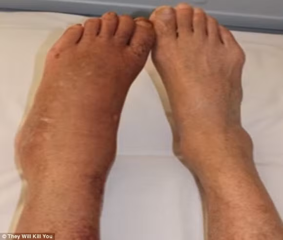 3. Hội chứng đau vùng phức tạp (CRPs) CRPs khiến người bệnh phải chịu đựng những cơn đau nghiêm trọng - đôi khi khiến cơ thể rơi vào tình trạng suy nhược. CRPs được xác định là do chấn thương dây thần kinh hoặc rối loạn thần kinh mãn tính do tổn thương mô. Triệu chứng này thường bắt đầu từ cánh tay, sau đó lan rộng khắp cơ thể. Các nghiên cứu cũng cho thấy rằng, sự đau đớn và khó chịu gây ra bởi bệnh CRPs có thể dẫn đến các vấn đề về sức khỏe tâm thần như trầm cảm và lo âu. Người bị CRPs sẽ cảm thấy nóng rát và đau nhói như bị vật nhọn đâm. Nó cũng có thể gây tê, sưng và đau khớp kèm chứng mất ngủ. Bệnh này có thể điều trị bằng vật lý trị liệu và đôi khi phải phẫu thuật, tuy nhiên, thời gian để phục hồi sẽ kéo dài và khá phức tạp.