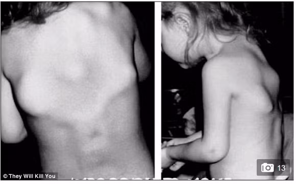 8. Hội chứng người hóa đá (FOP) Với khoảng 800 trường hợp trên toàn thế giới mắc hội chứng hóa đá hiếm gặp này. FOP là một căn bệnh rất hiếm gặp và gần như không thể điều trị. FOP gây tê liệt hệ thống phục hồi các mô của cơ thể, thay vào đó chúng lại biến cơ bắp, dây chằng và các mô bằng cách chuyển chúng thành xương. Các xương mới được hình thành này không có khớp, nó nhanh chóng lan rộng khắp cơ thể khiến cho người bệnh bị bất động, không thể dịch chuyển.