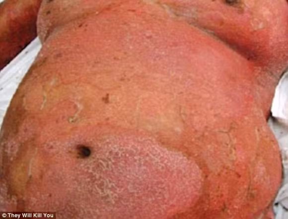 6. Vibrio vulnificus Đây là một bệnh do vi khuẩn vô cùng nguy hiểm, có thể gây nhiễm trùng nghiêm trọng. Bệnh này xâm nhập vào cơ thể thông qua ăn sò, ốc sống hoặc tiếp xúc qua vết thương hở. Bệnh này đi kèm với nhiều triệu chứng như buồn nôn, tiêu chảy cấp, viêm da phồng rộp và đau bụng dữ dội. Vibrio vulnificus gây suy giảm hệ miễn dịch, ảnh hưởng đến cả gan và máu. Nếu người bệnh không được chữa trị kịp thời thì sẽ dẫn đến tử vong. Bệnh này được phát hiện vào khoảng năm 1979.