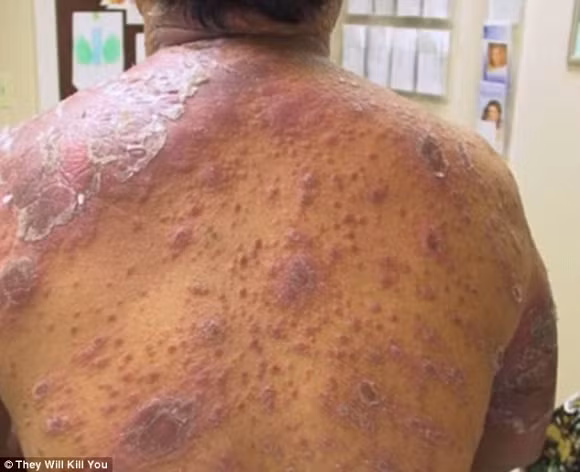 4. Bệnh phong Bệnh phong là một bệnh truyền nhiễm ở da, mắt, thần kinh và đường hô hấp. Nó xâm nhập vào cơ thể qua việc tiếp xúc với một loại vi khuẩn gọi là Mycobacterium. Các triệu chứng có thể thấy rõ là thị lực kém, mất cảm giác ở các chi hoặc khu vực bị nhiễm bệnh. Bệnh gây tổn thương các dây thần kinh ngoại biên (nhất là các chi), làm bệnh nhân mất cảm giác ngoài da và yếu liệt các cơ từ từ. Chính việc mất cảm giác này mà bệnh nhân phong thường xuyên bị các chấn thương, dần dần mất hẳn bàn tay hoặc bàn chân của mình. Bệnh phong đã được phát hiện từ rất lâu, những khu vực có người mắc bệnh thường bị cách ly nhằm chống việc lây lan.