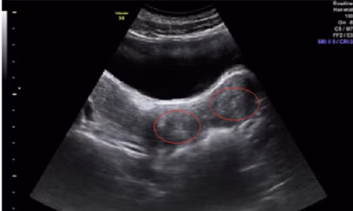Hình ảnh siêu âm cho thấy hai tử cung đều dị dạng. (Ảnh do bệnh viện cung cấp)