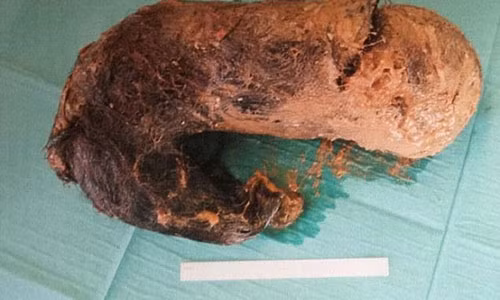 Kinh ngac lay bui toc nang 1,3 kg trong bung co gai