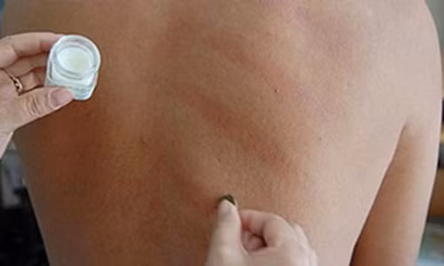 Ai nên cạo gió, ai nên tránh? Ai nen cao gio, ai nen tranh?