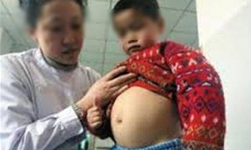 Cậu bé 4 tuổi mang thai chính người anh em song sinh của mình.